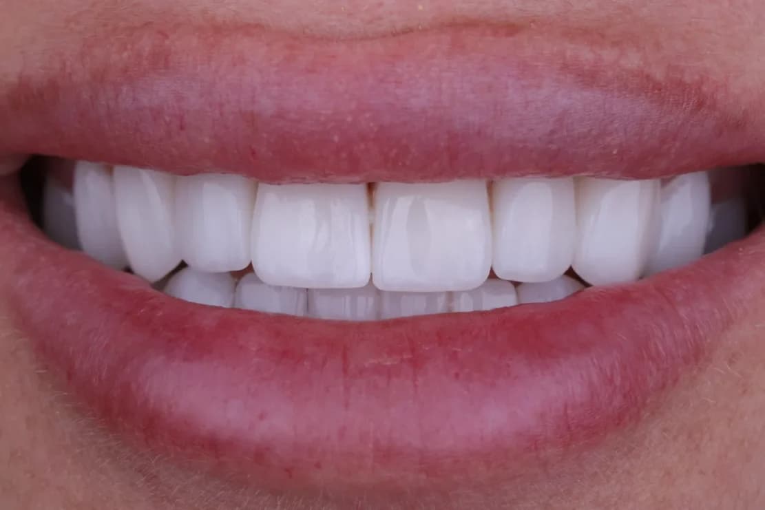 After Hollywood Smile - DentSpa