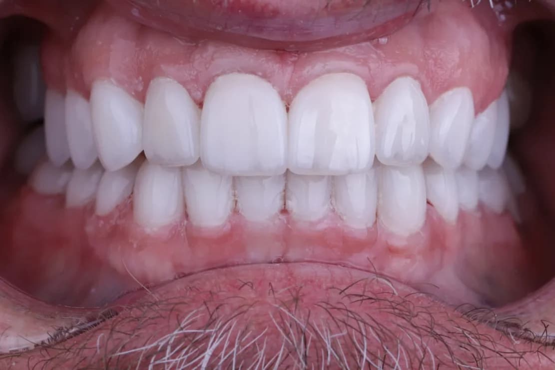 After Hollywood Smile - DentSpa