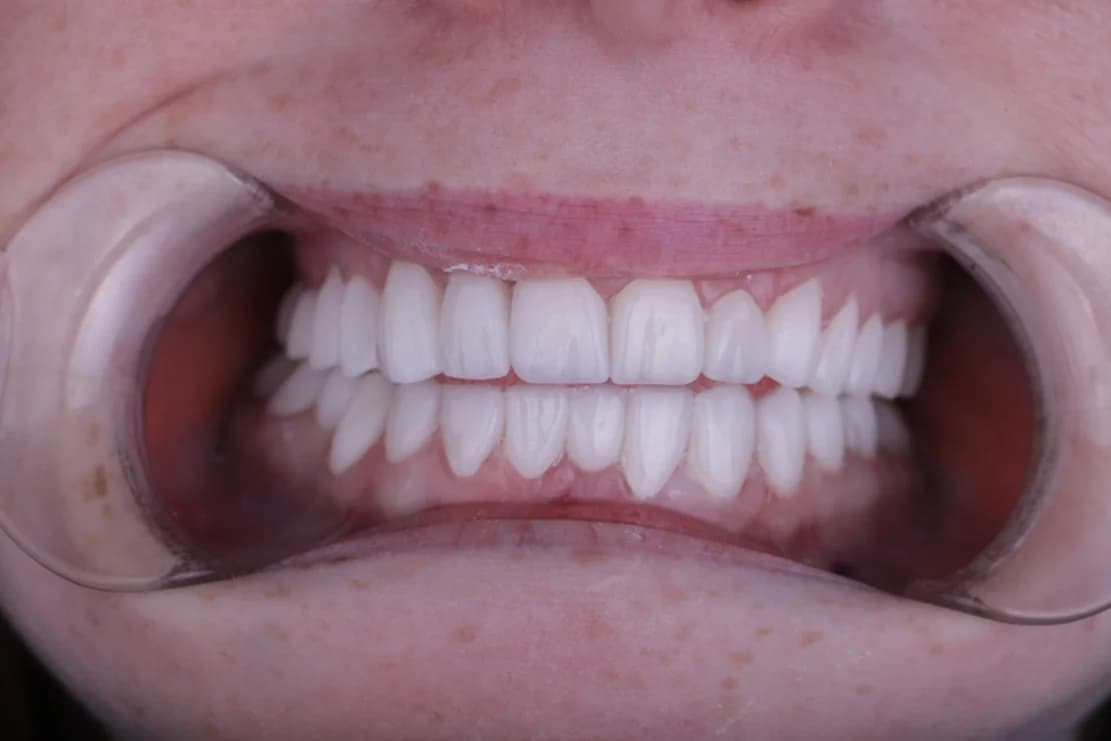 After Dental Veneers - DentSpa