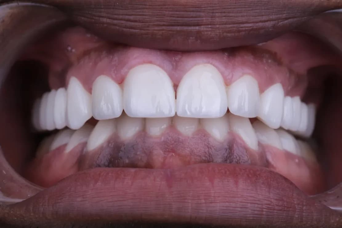 After Hollywood Smile - DentSpa