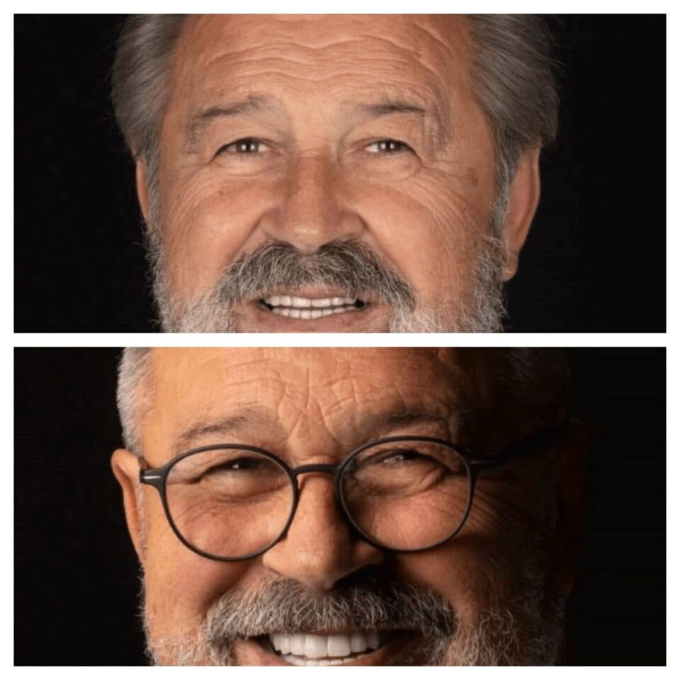 After Hollywood Smile - Vitrin Clinic