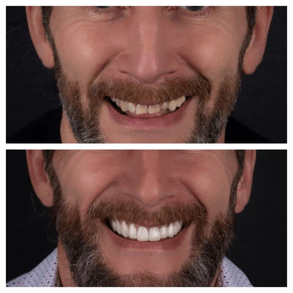 After Hollywood Smile - Vitrin Clinic