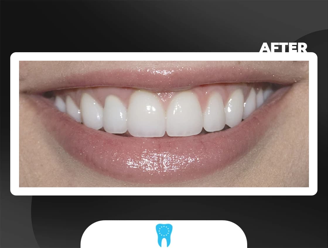 After Smile Design - AvrupaDiş