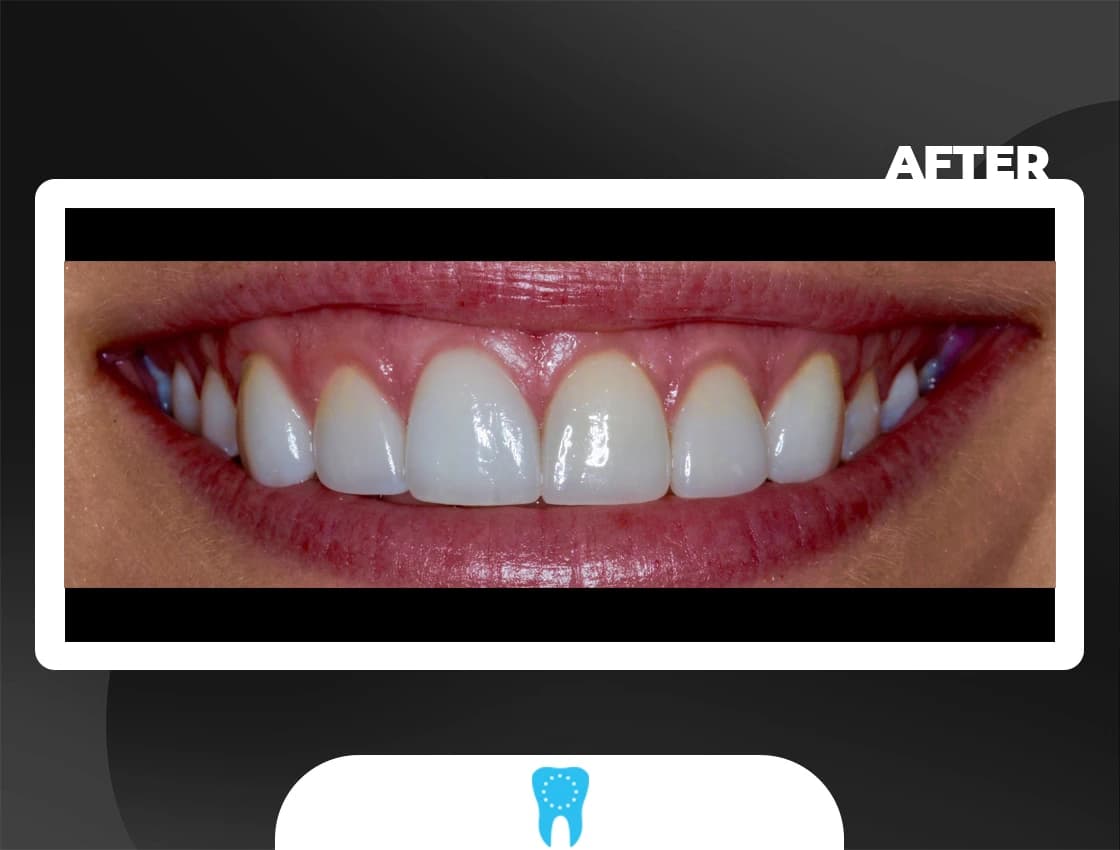 After Smile Design - AvrupaDiş