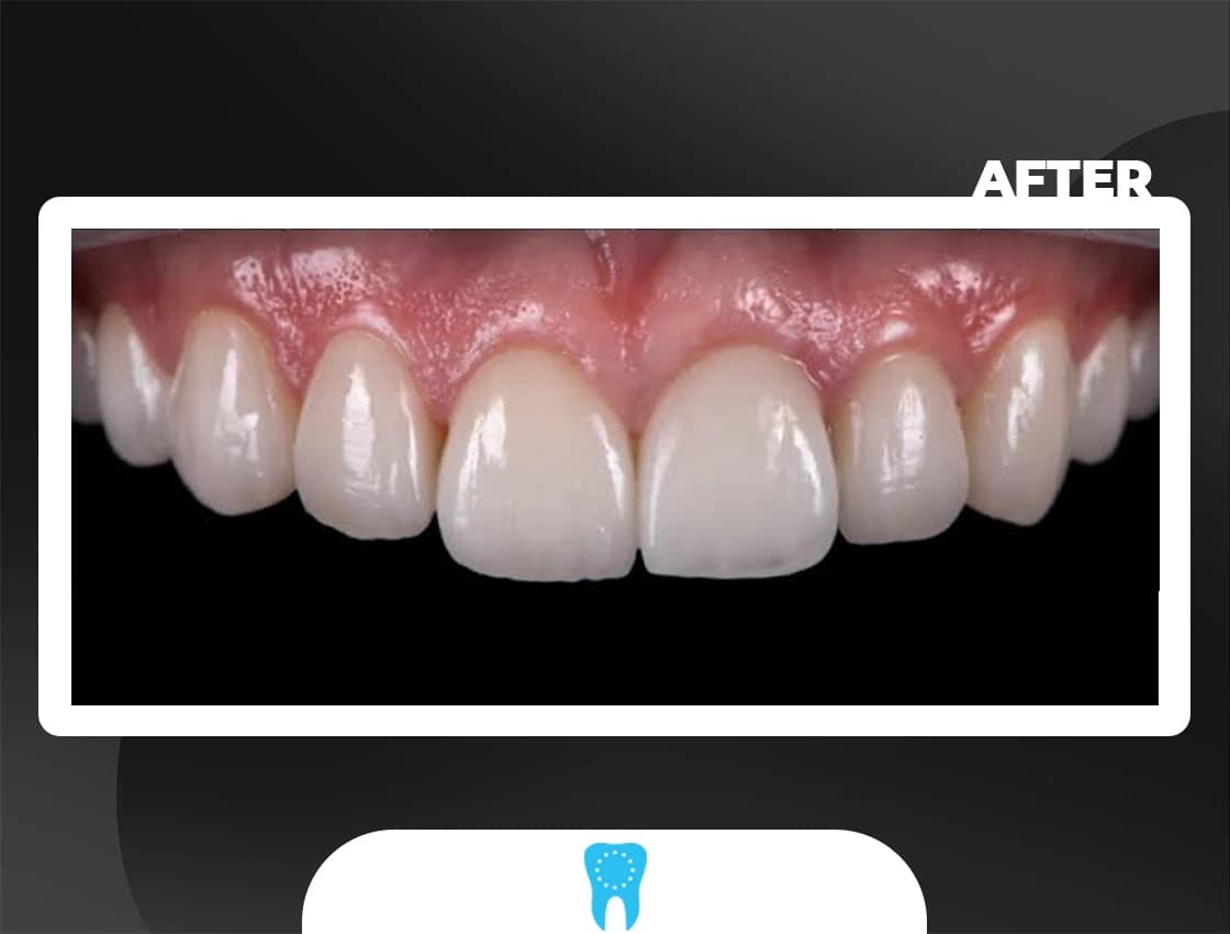 After Smile Design - AvrupaDiş