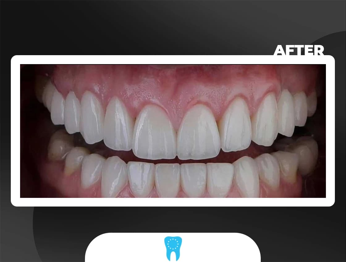 After Laminate Veneers - AvrupaDiş
