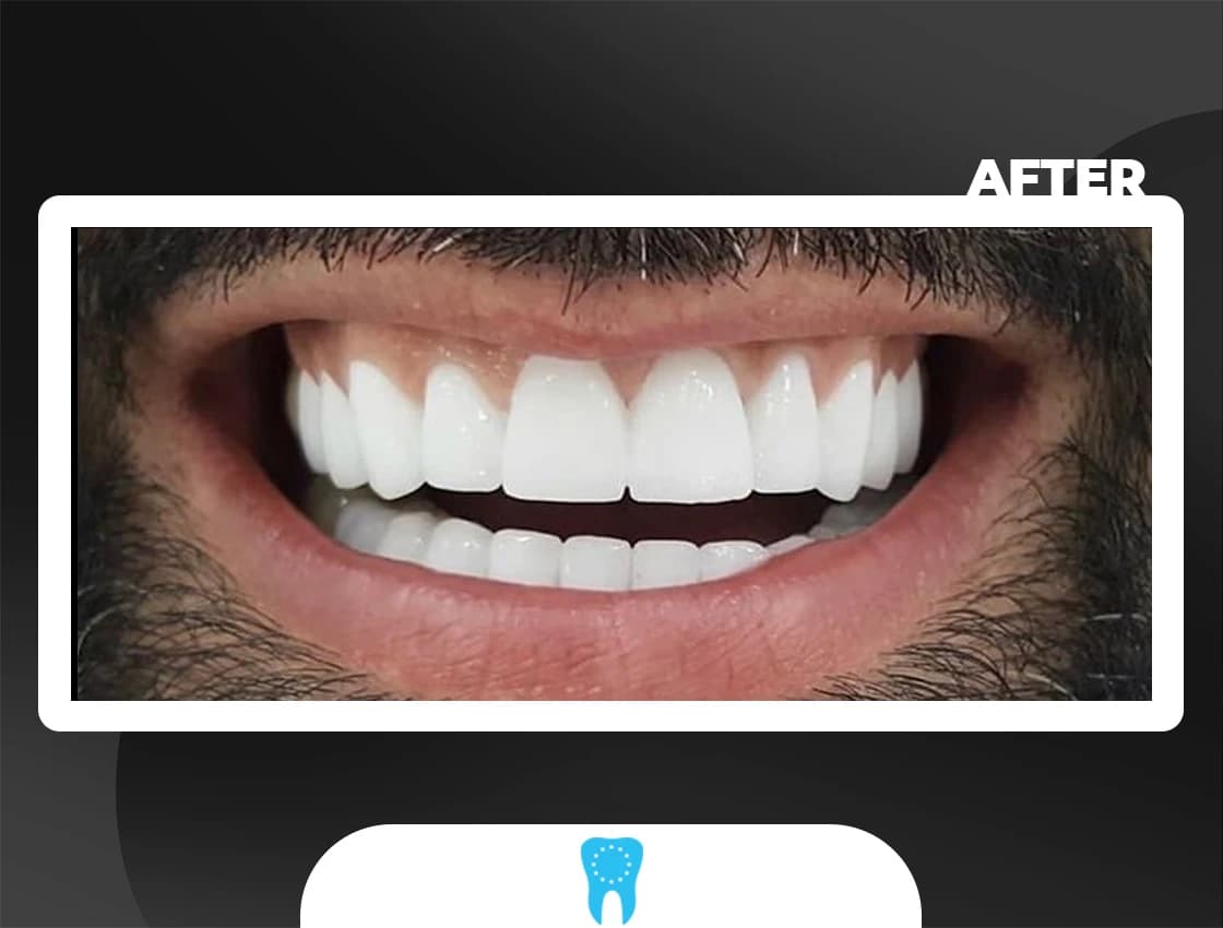 After Zirconium Crowns - AvrupaDiş