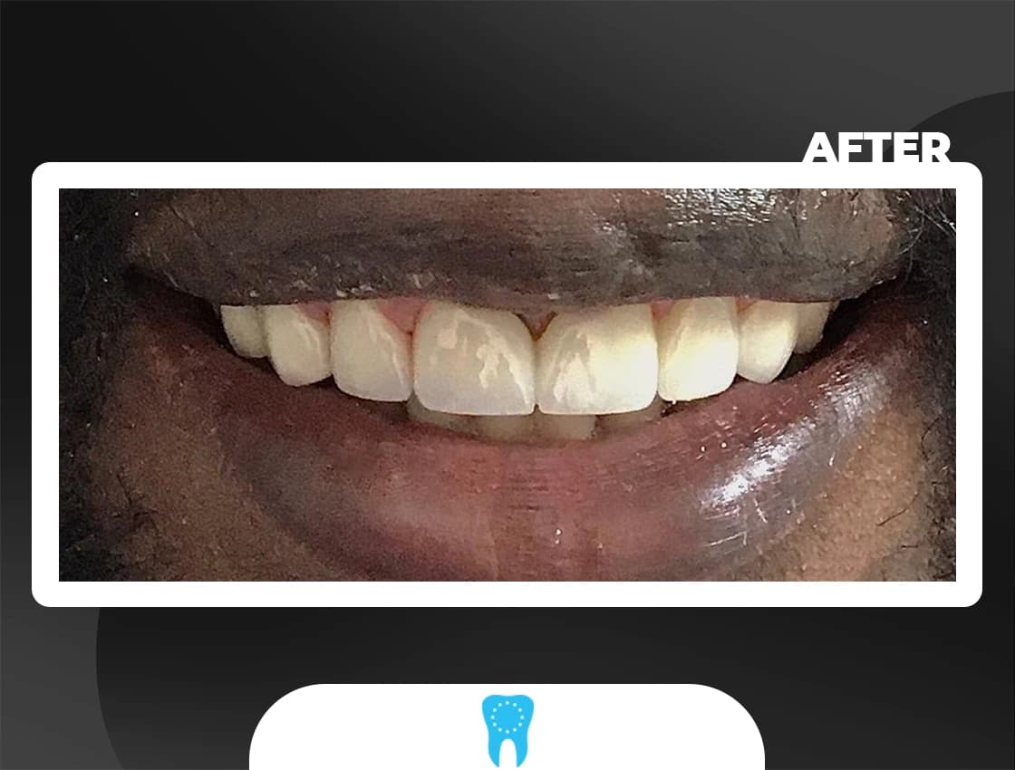 After Hollywood Smile - AvrupaDiş