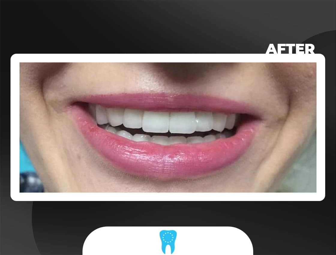 After Full Mouth Rehab - AvrupaDiş