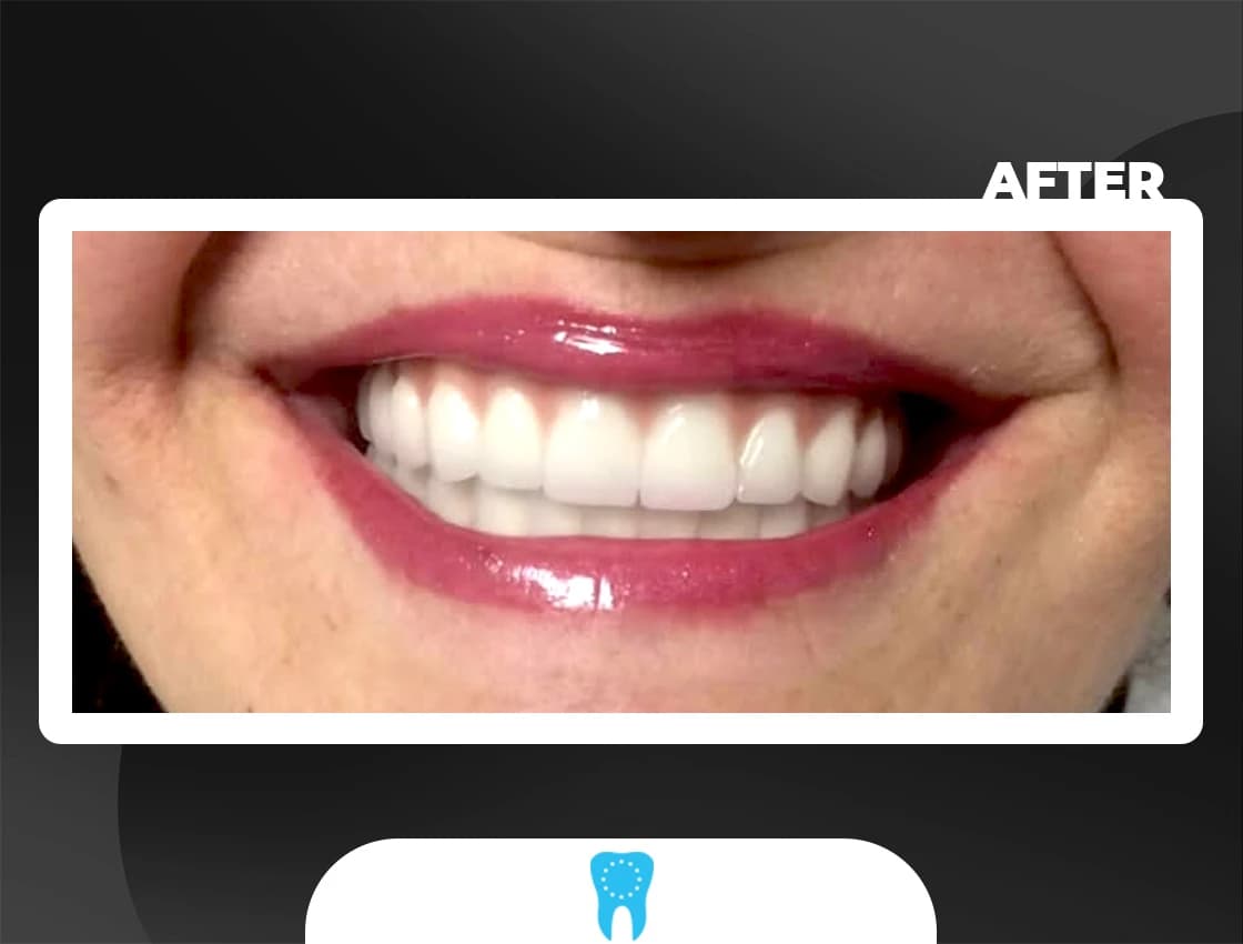 After Porcelain Veneers - AvrupaDiş