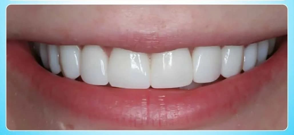 After Smile Design