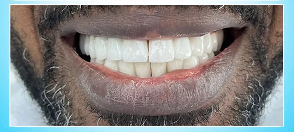 After Dental Implants