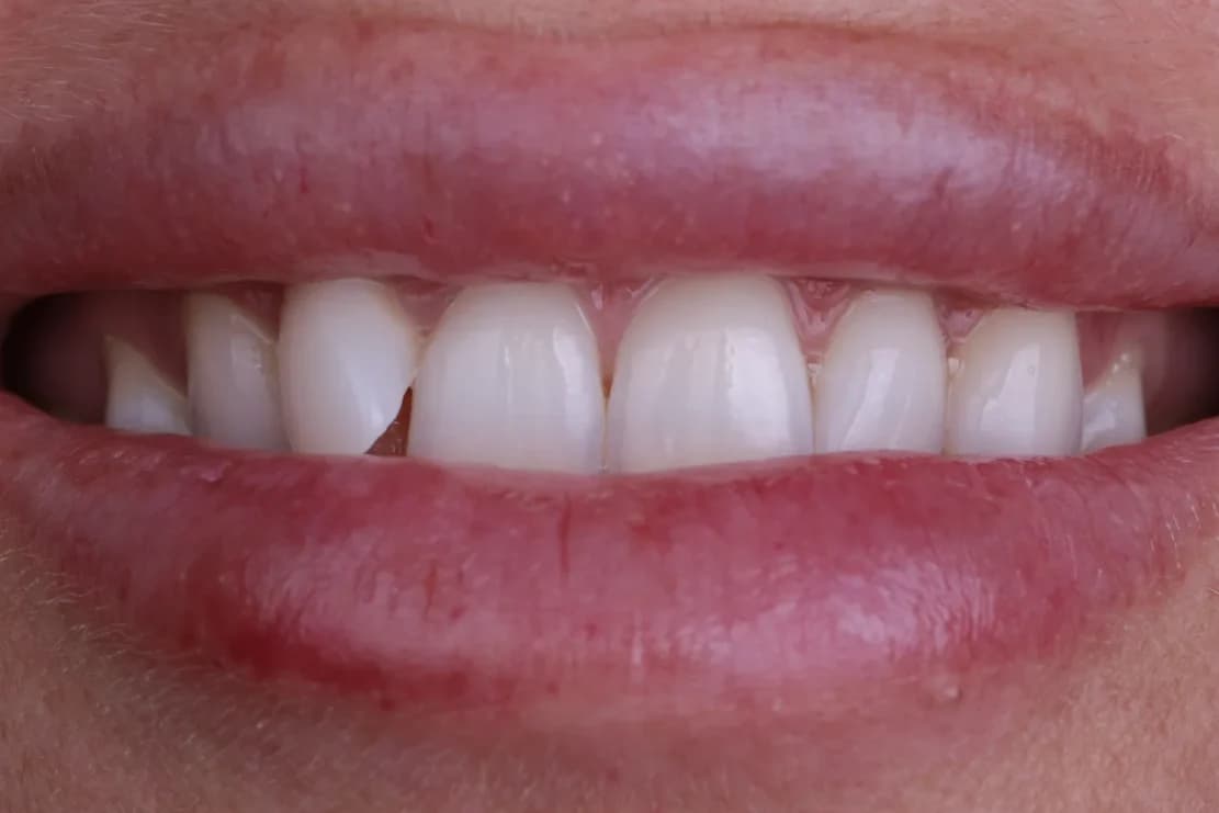Before Hollywood Smile - DentSpa