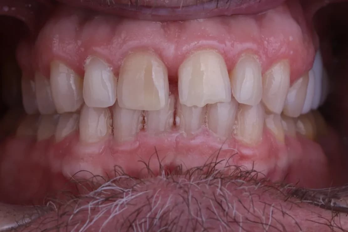 Before Hollywood Smile - DentSpa