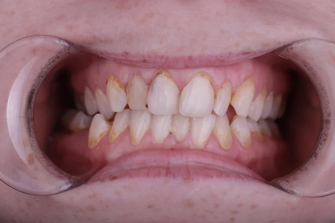 Before Dental Veneers - DentSpa