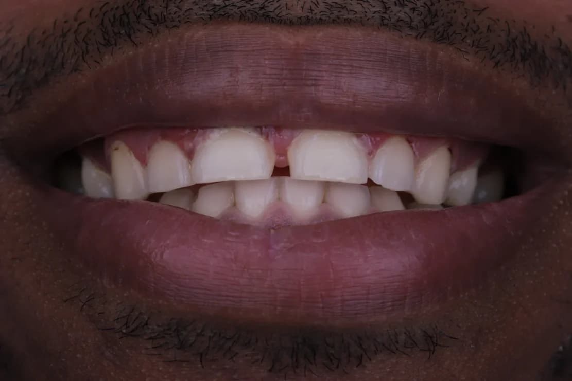 Before Hollywood Smile - DentSpa