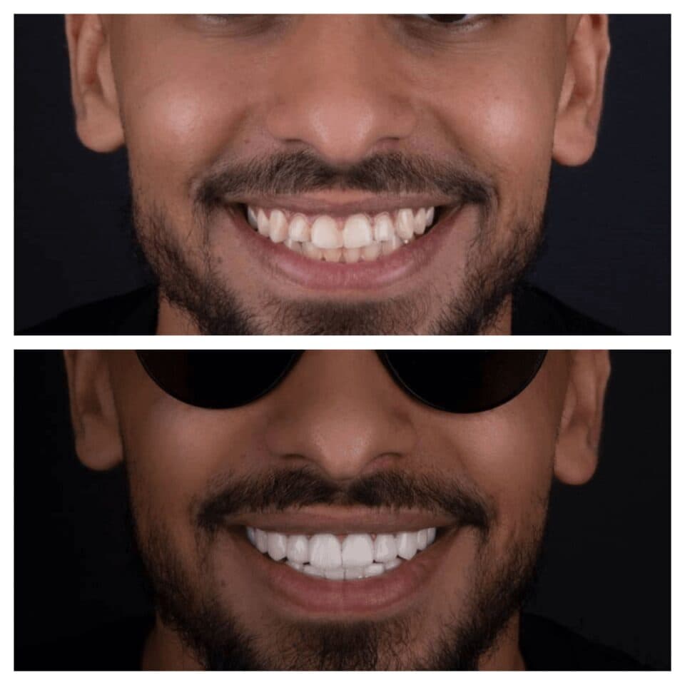 Before Dental Veneers - Vitrin Clinic