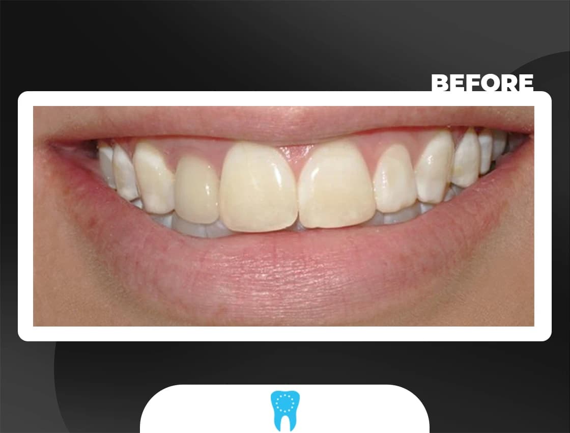 Before Smile Design - AvrupaDiş