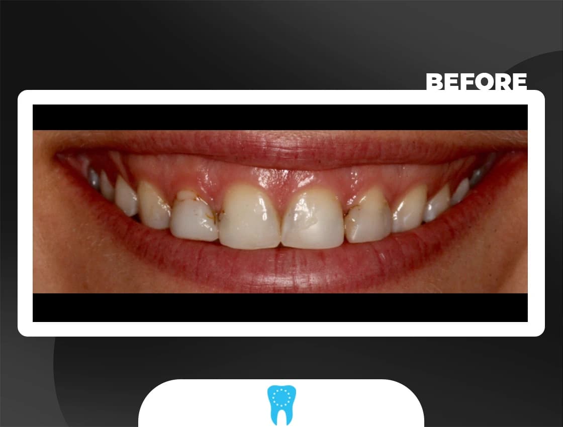 Before Smile Design - AvrupaDiş
