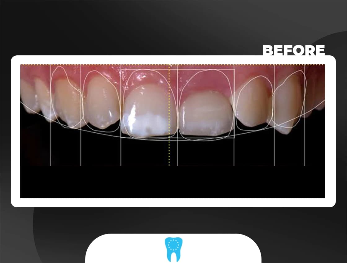 Before Smile Design - AvrupaDiş