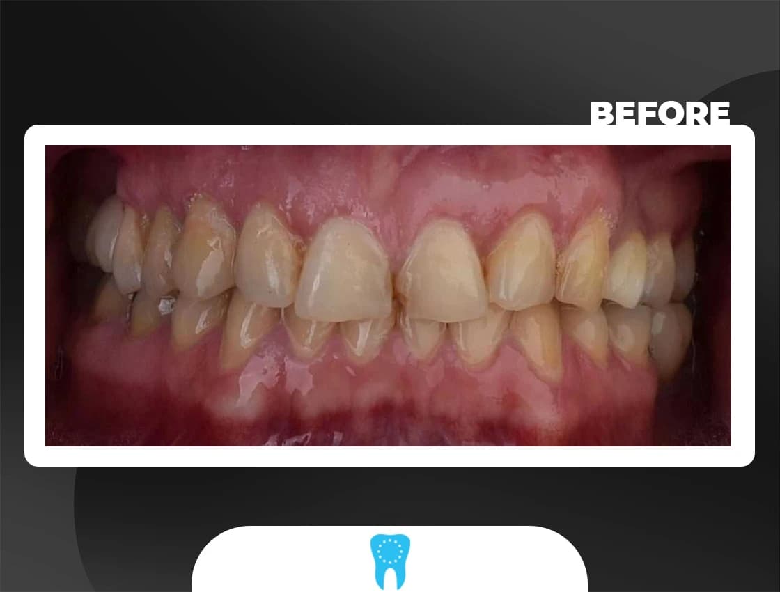 Before Laminate Veneers - AvrupaDiş