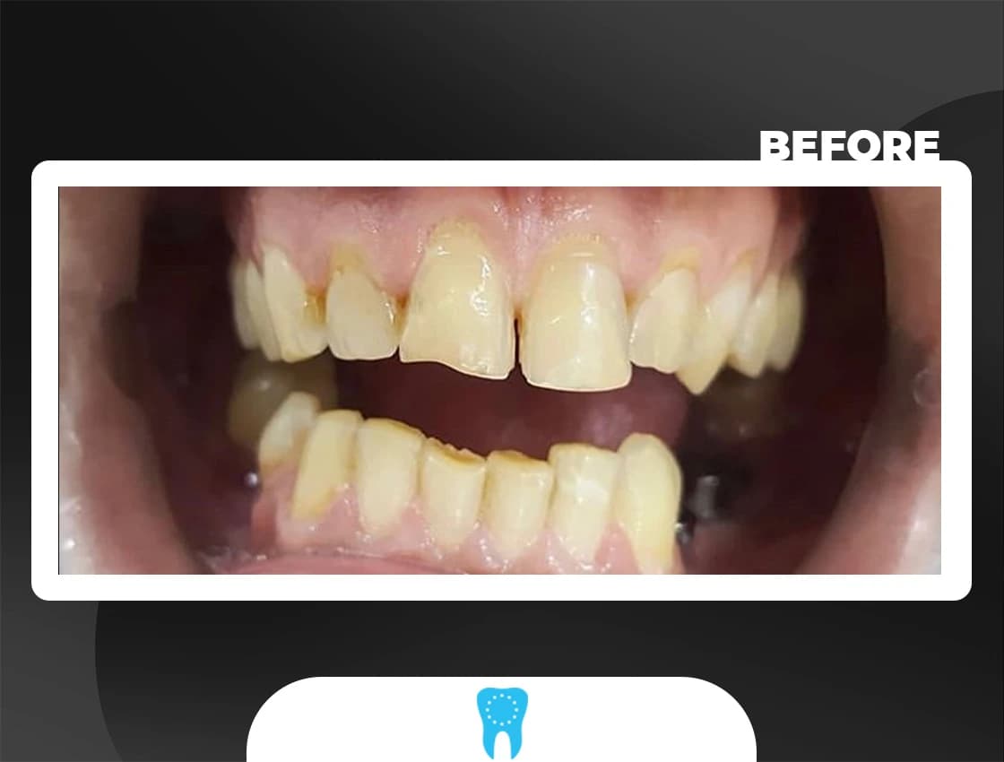 Before Zirconium Crowns - AvrupaDiş