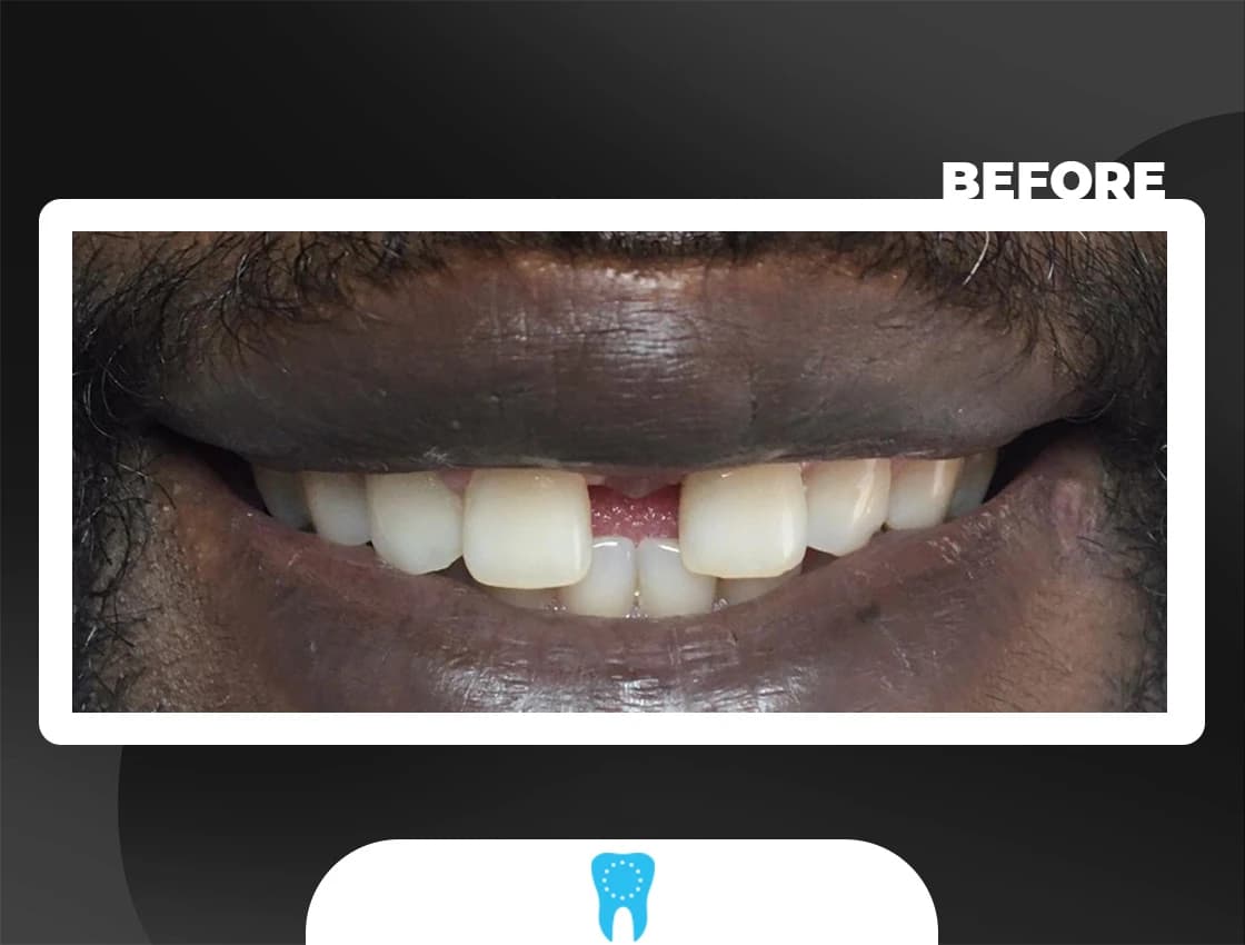 Before Hollywood Smile - AvrupaDiş