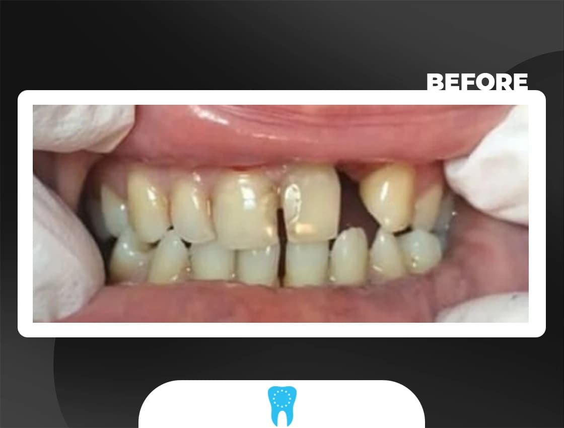 Before Full Mouth Rehab - AvrupaDiş