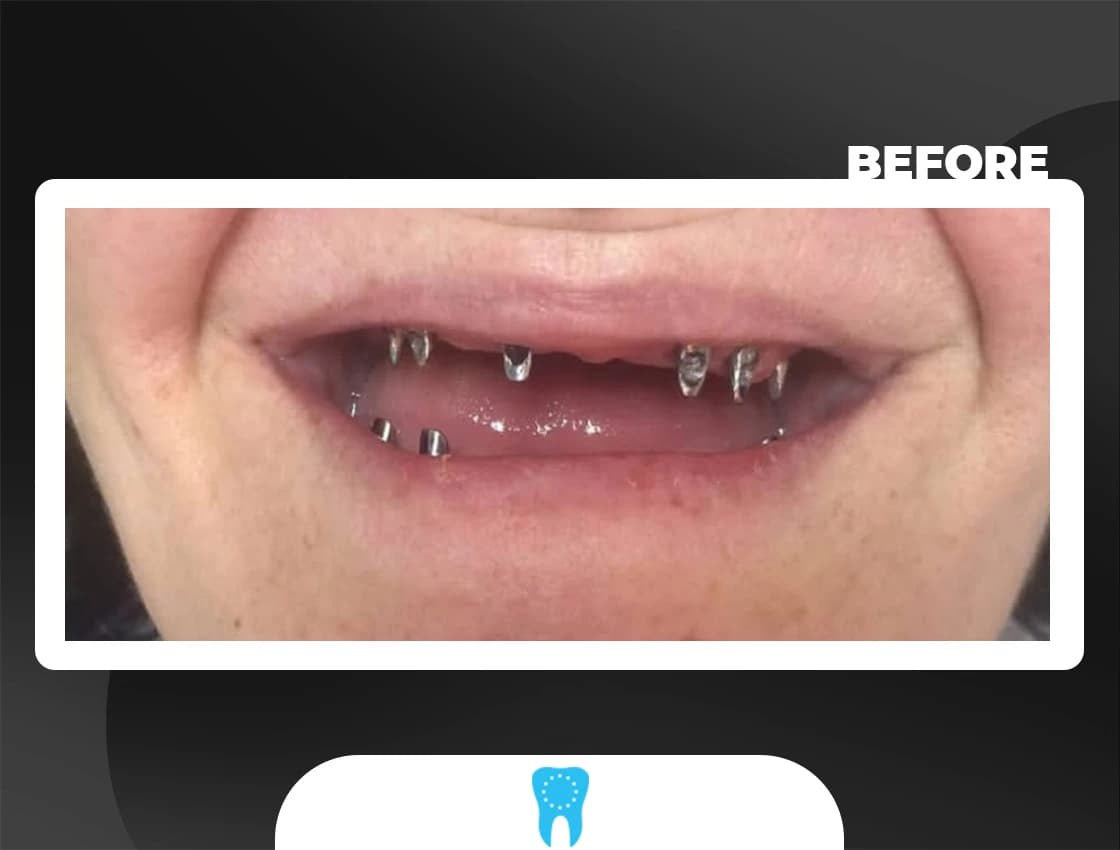 Before Porcelain Veneers - AvrupaDiş