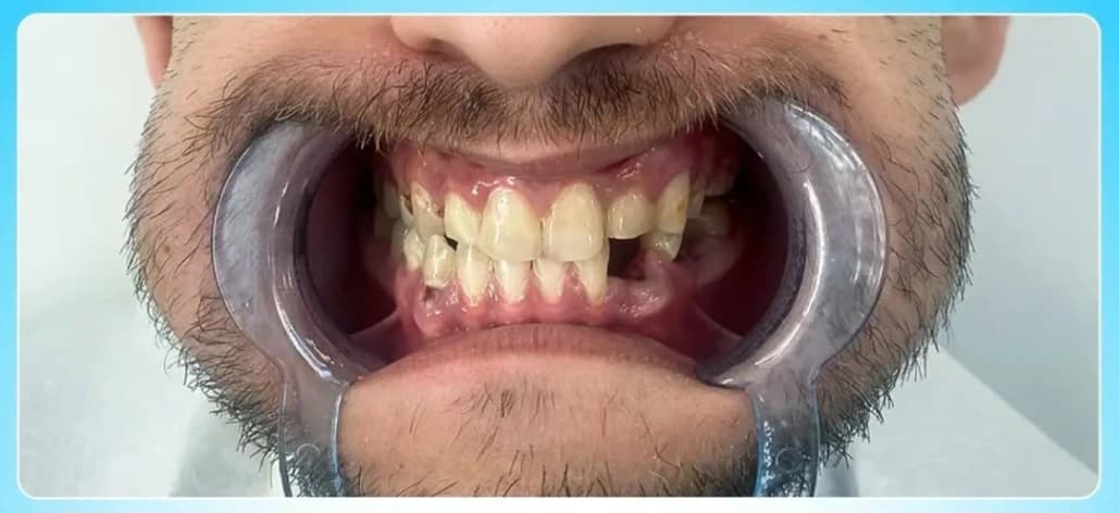 Before E-max Crowns - AvrupaDiş