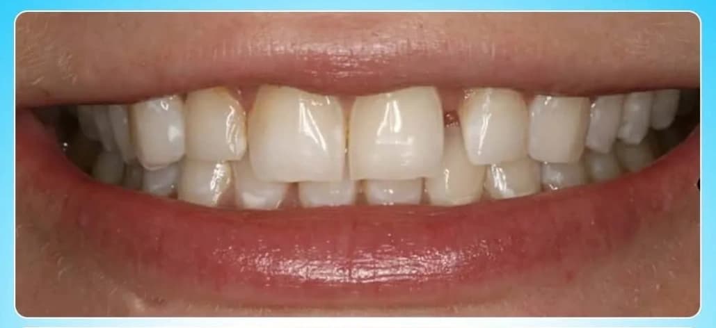 Before Smile Design