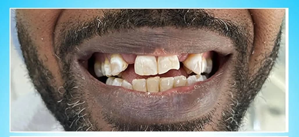 Before Dental Implants