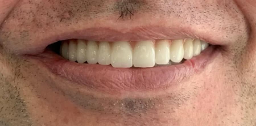 Smile Design before and after