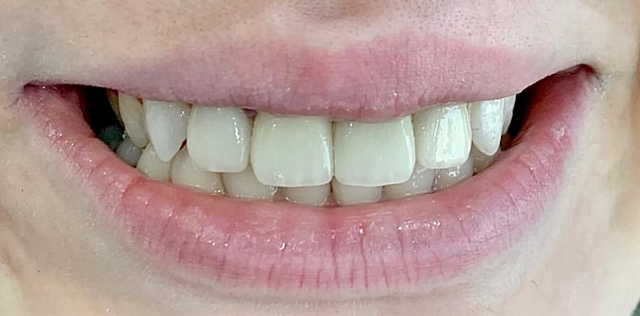 Orthodontic Treatment - Tasarım Dental Clinic