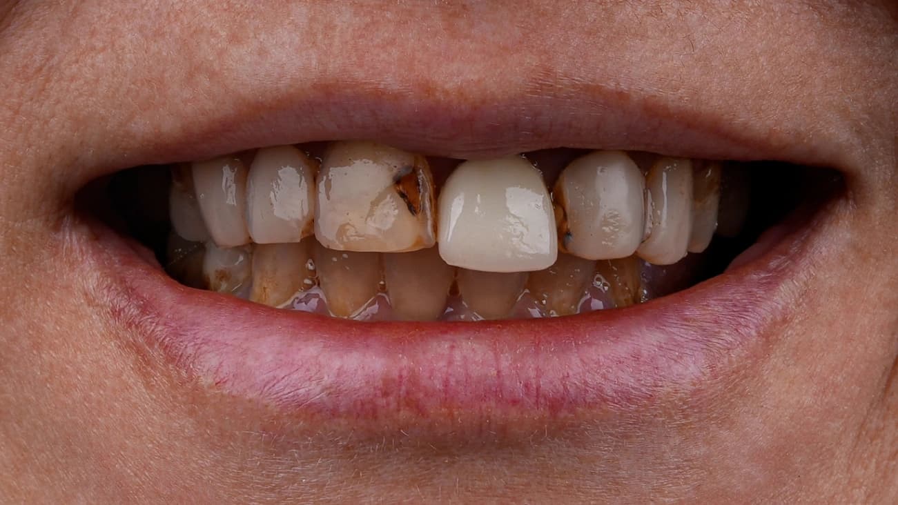 Before Dental Veneers - Vitrin Clinic