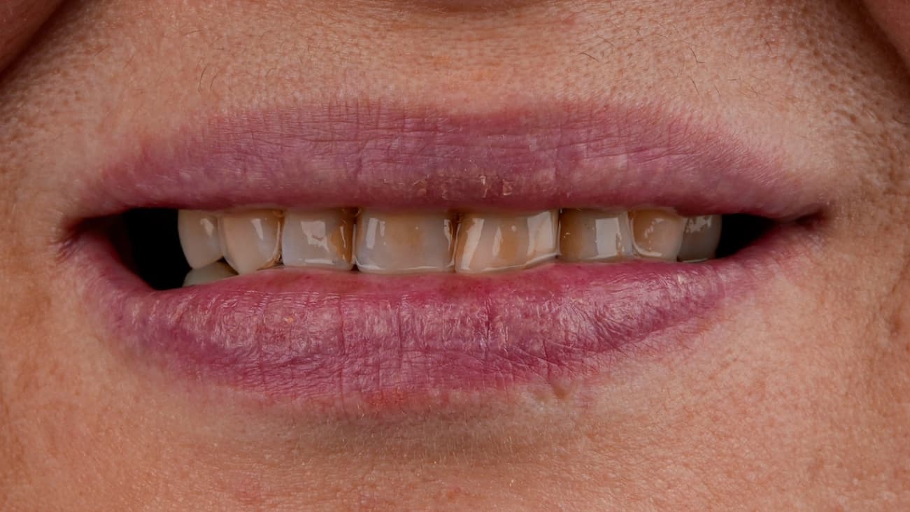 Before Hollywood Smile - Vitrin Clinic